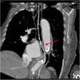 Case report: an aortic aneurysm as cause of pseudoachalasia | BMC ...